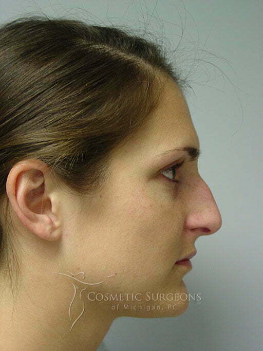 nose-surgery-15.jpg