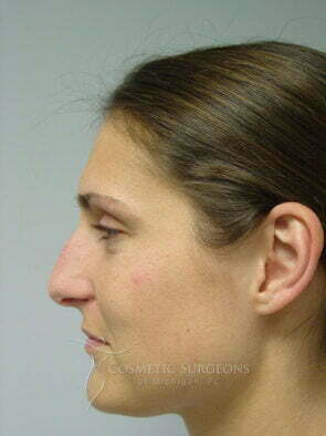 nose-surgery-19.jpg