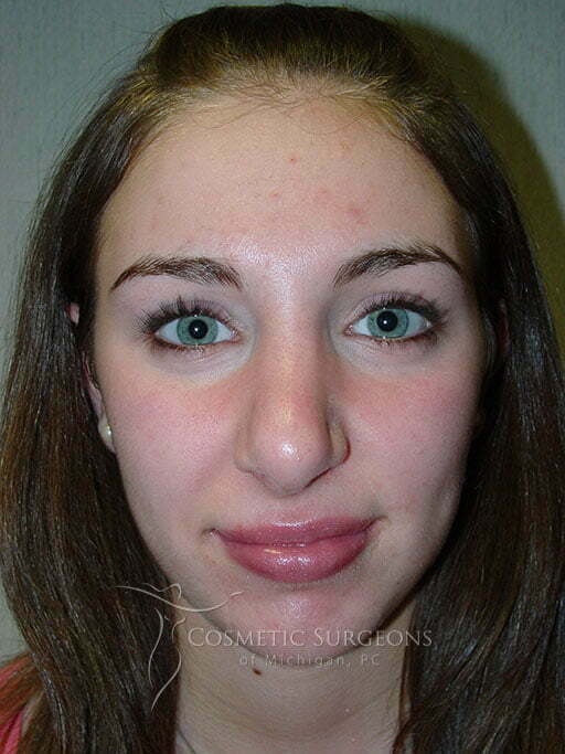 Nose Surgery patient 3321