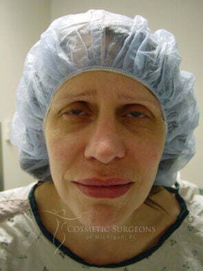 Nose Surgery patient 3354