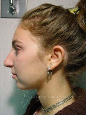 nose-surgery-5.jpg