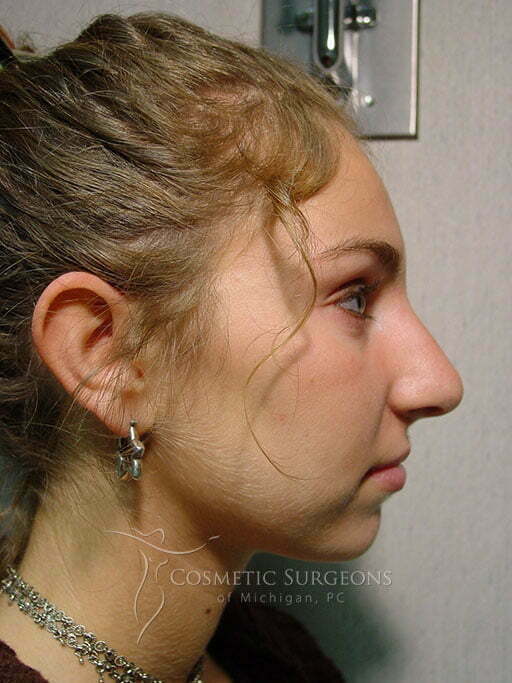 nose-surgery-9.jpg
