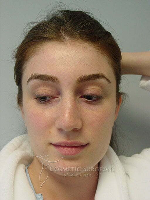 Otoplasty patient 3396