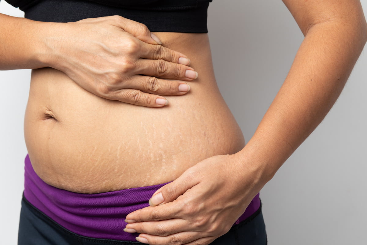 Women Show off the belly after birth with Stretch Marks 