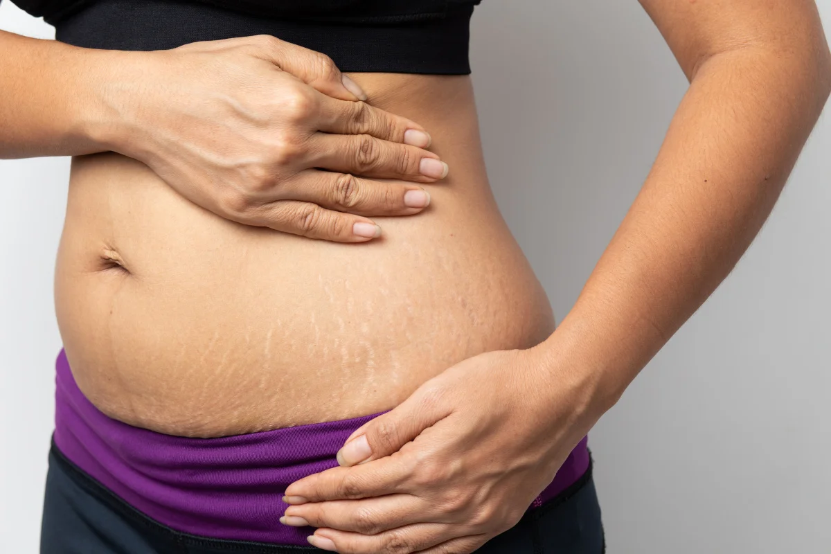 Can a Tummy Tuck Treat Stretch Marks? - Cosmetic Surgeons of
