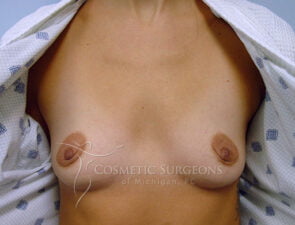 Breast Augmentation patient 4057
