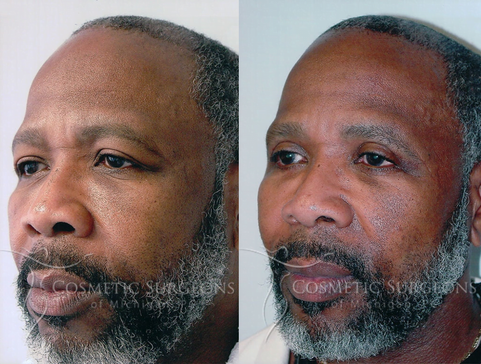 Image of patient before and after eyelid lift