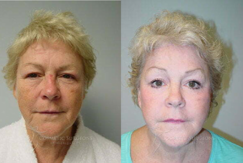 Patient before and after brow lift with a more open eye appearance, smoother forehead, and generally younger appearance in the "after" photo