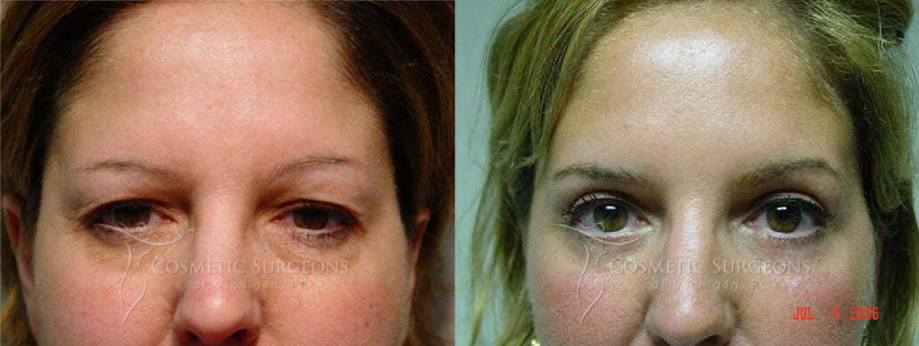 Actual patient before and after eyelid lift