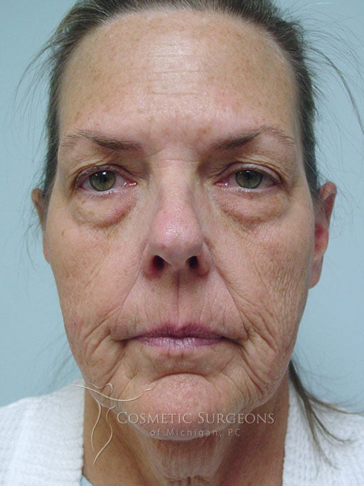 Facelift patient 4549